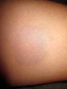 bruise hidden with make-up