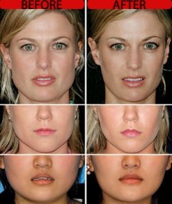 lens5715152_1246755218botox_jaw_reduction_surgery_uk