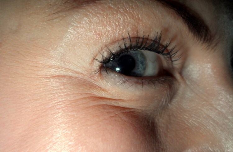 See? Lots of lines. The kind that would eventually become permanent if I didn't Botox.