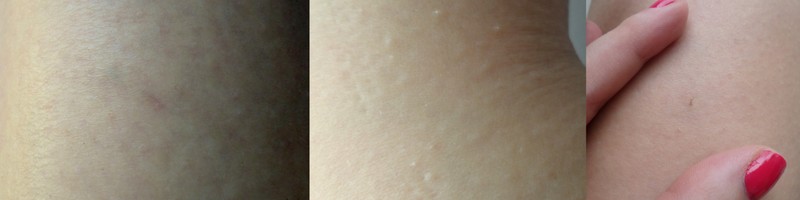 Ankle, knee and thigh six weeks after treatment.