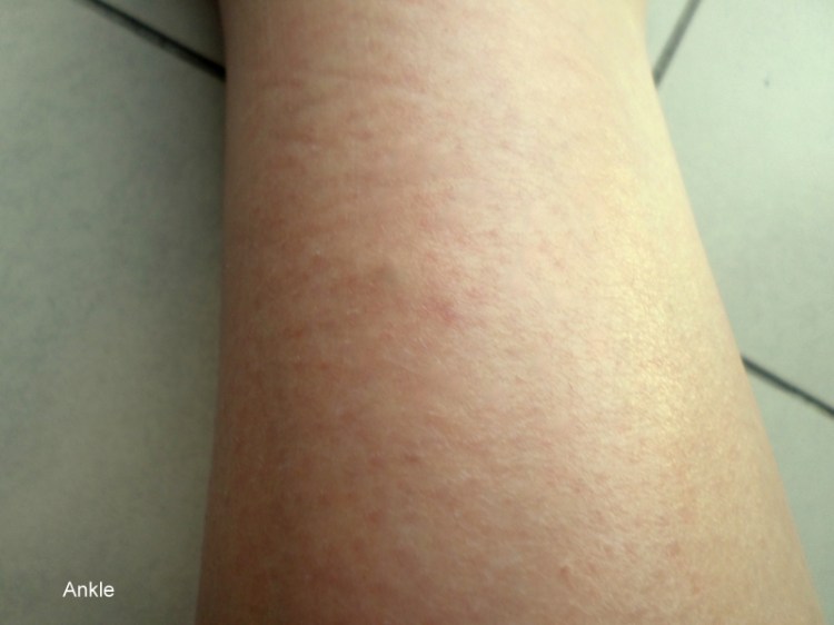 No redness, no bruising, a bunch of nothing to look at really.