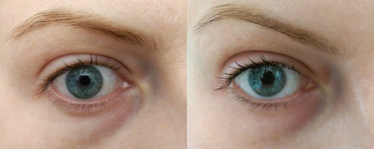 Puffy on the left, more lifted on the right.